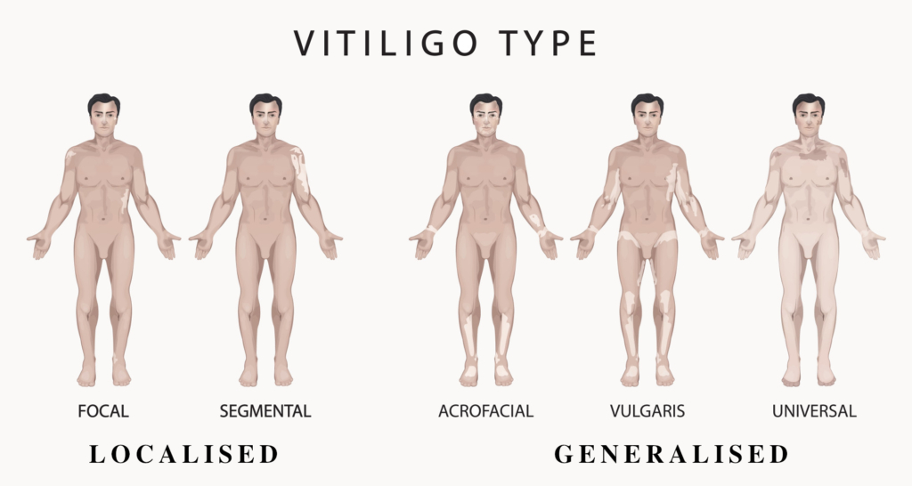 What is Vitiligo? | Causes, Signs, Symptoms, & More | Vitiligo Society