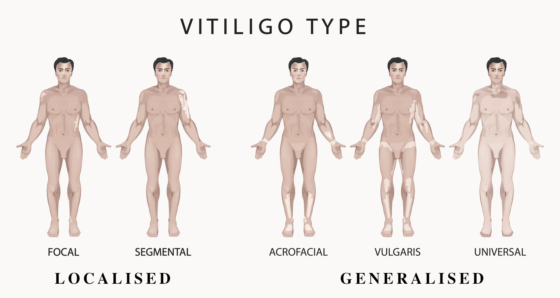 What is Vitiligo?, Causes, Signs, Symptoms, & More