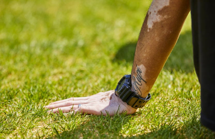 Instagrammer Turns Her Vitiligo Into Body Art | Teen Vogue