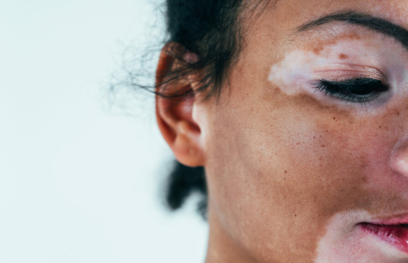 new research on vitiligo
