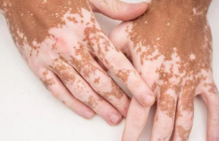 new research for vitiligo